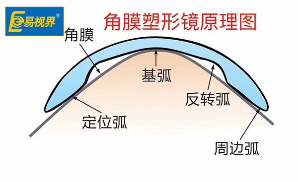 近視以后可否呆角膜塑形鏡【易視界眼健康管理機(jī)構(gòu)】