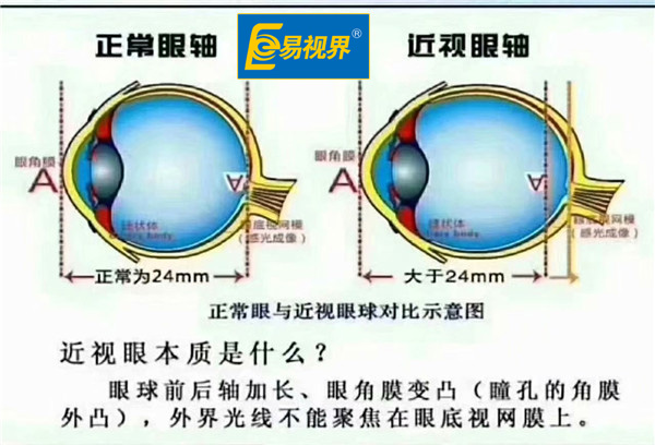 正常眼與近視眼球?qū)Ρ仁疽鈭D