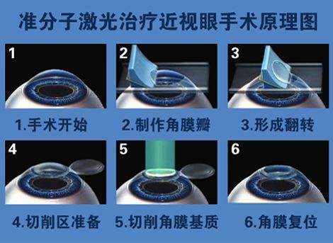 激光手術過程