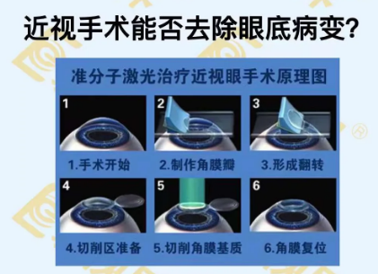 近視手術(shù)能否去除眼底病變？