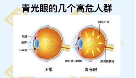 青光眼的幾個高危人群？