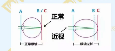 哪個年齡近視度數(shù)最容易增長？